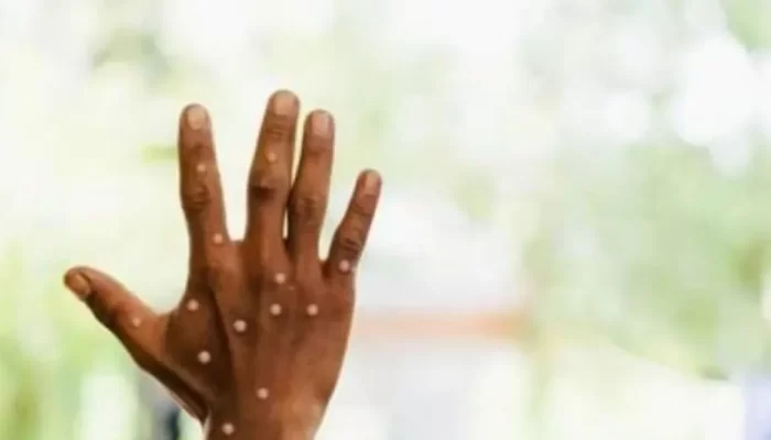 Satu Warga Kabupaten Cirebon Positif Cacar Monyet, Ada Riwayat Perjalanan dari Luar Kota